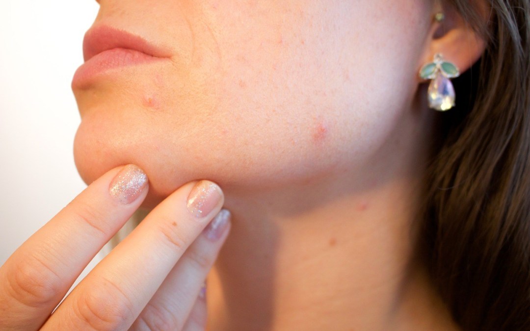 How to cure acne naturally. Grandmas Home Remedy